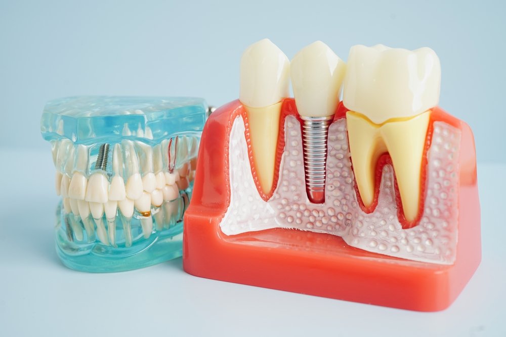 Dental Implants