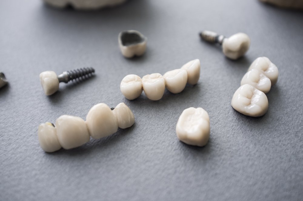 Implant Repair