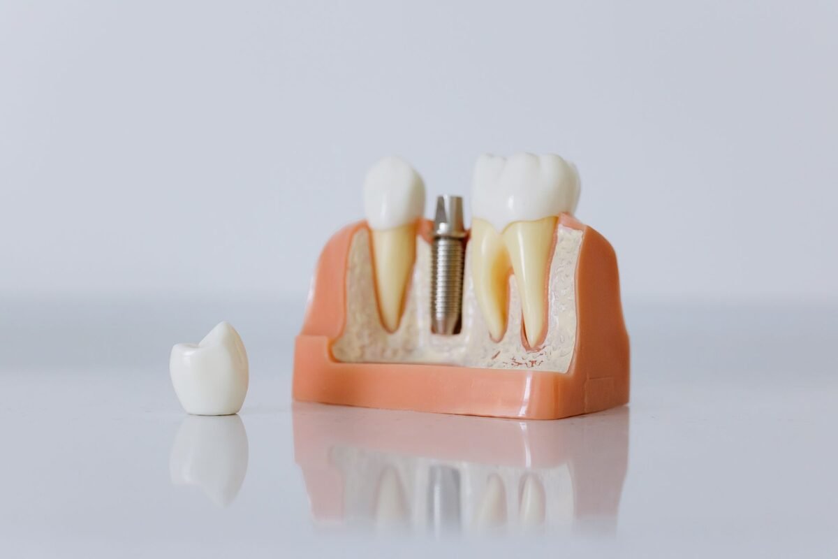 Single Tooth Implants